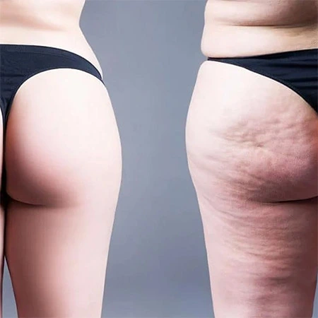 Tratamento para Lipedema em São Paulo